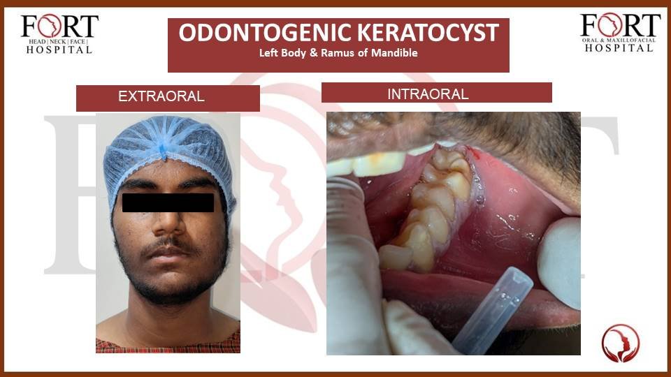 Cyst at forthospital tolichowki