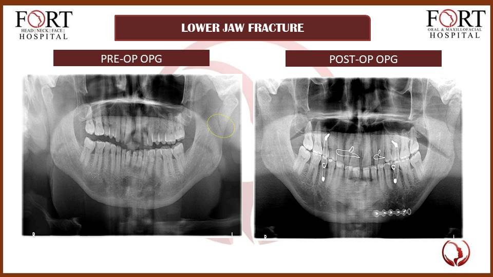 tramua at fort hospital tolichowki
