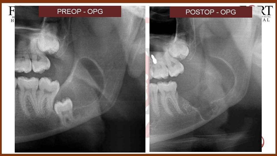 Cyst at fort hospital tolichowki