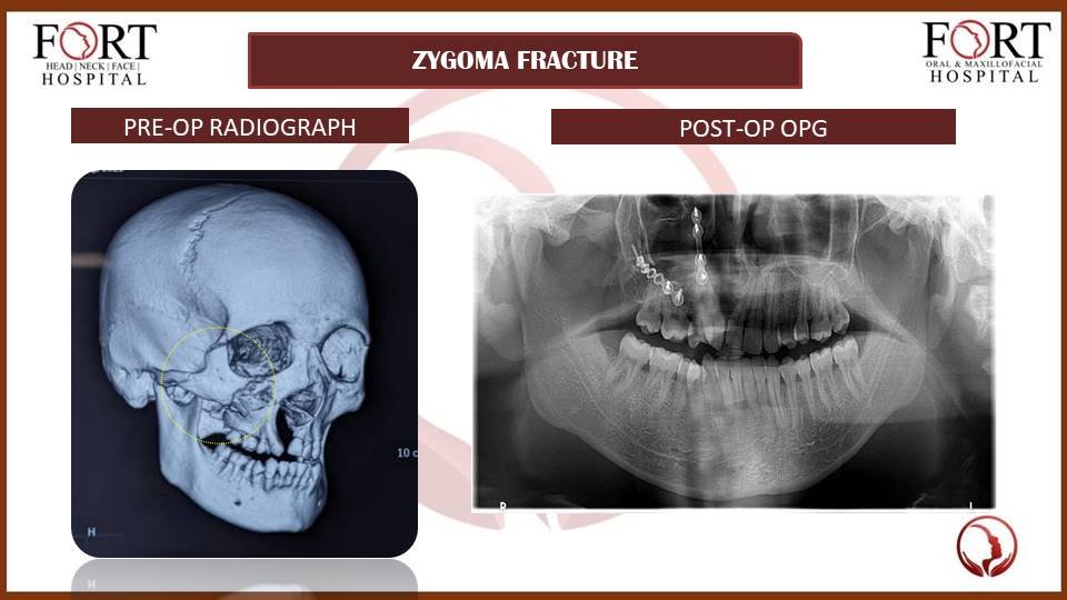 Cyst at tolichowki