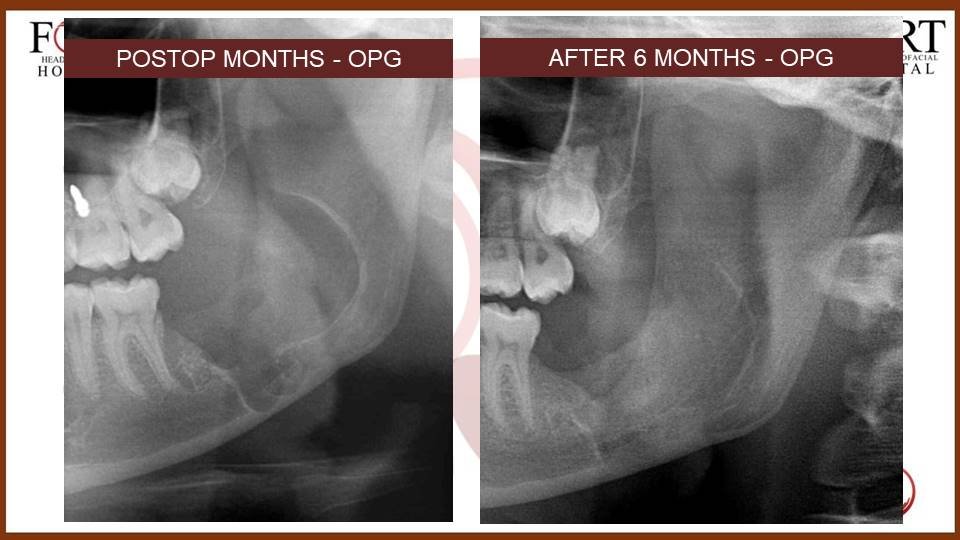 Cyst at fort hospital tolichowki