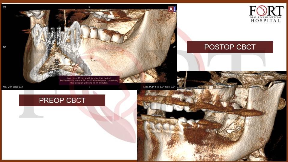 Cyst at fort hospital tolichowki