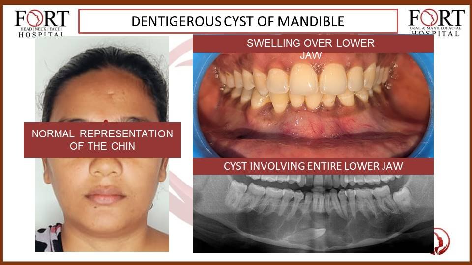 Cyst at fort hospital tolichowki