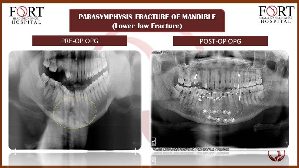 cyst at fort hospital tolichowki