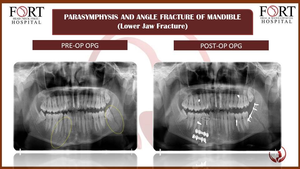 cyst at fort hospital tolichowki