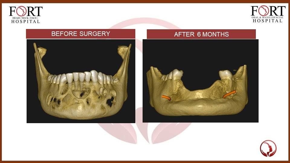 Cyst at fort hospital tolichowki